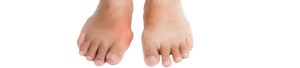 Hallux valgus