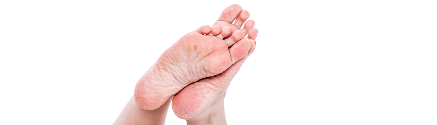 Sortie Rook thema Likdoorn (eksteroog) verwijderen ? - Hanssen Footcare