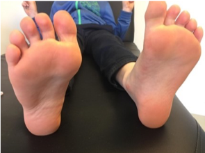 Ziekte van Sever hielpijn bij kinderen Hanssen Footcare